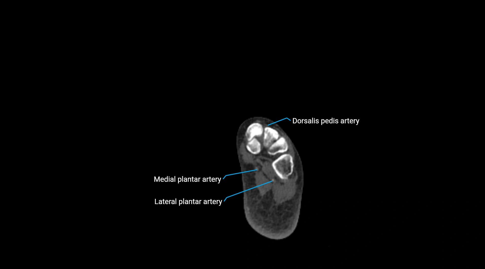 CTA lower limb cross sectional anatomy labelled image _291.webp
